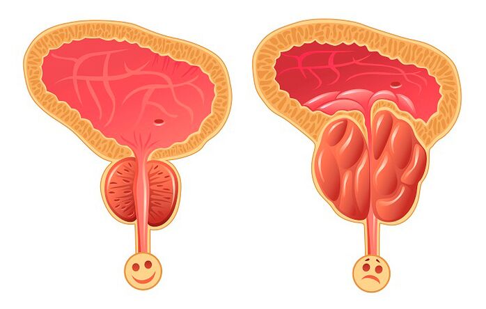 Φυσιολογικός και φλεγμονώδης προστάτης